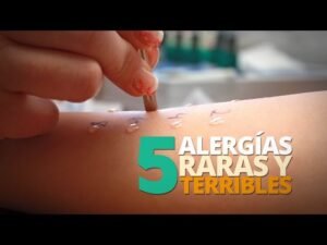 Las 5 alergias más raras